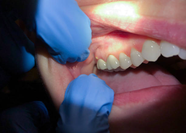Best Walk-In Emergency Dentist in Maple Heights Lake Desire, WA