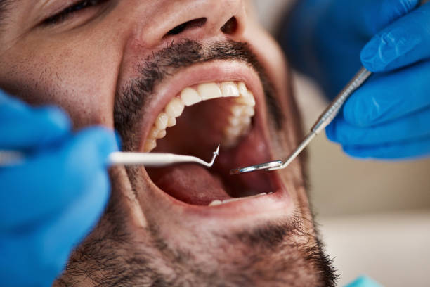 Best Walk-In Emergency Dentist in Maple Heights Lake Desire, WA